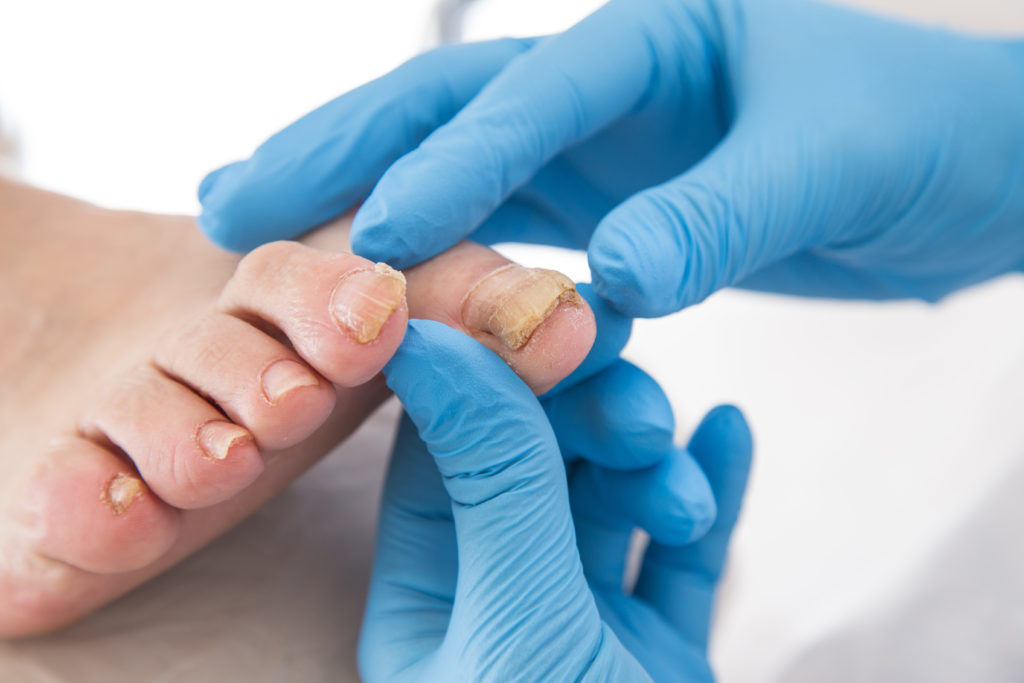 Nail Surgery