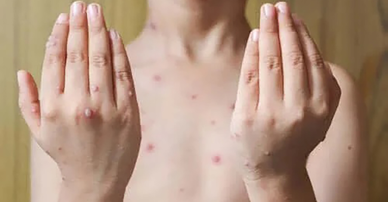 Pemphigus