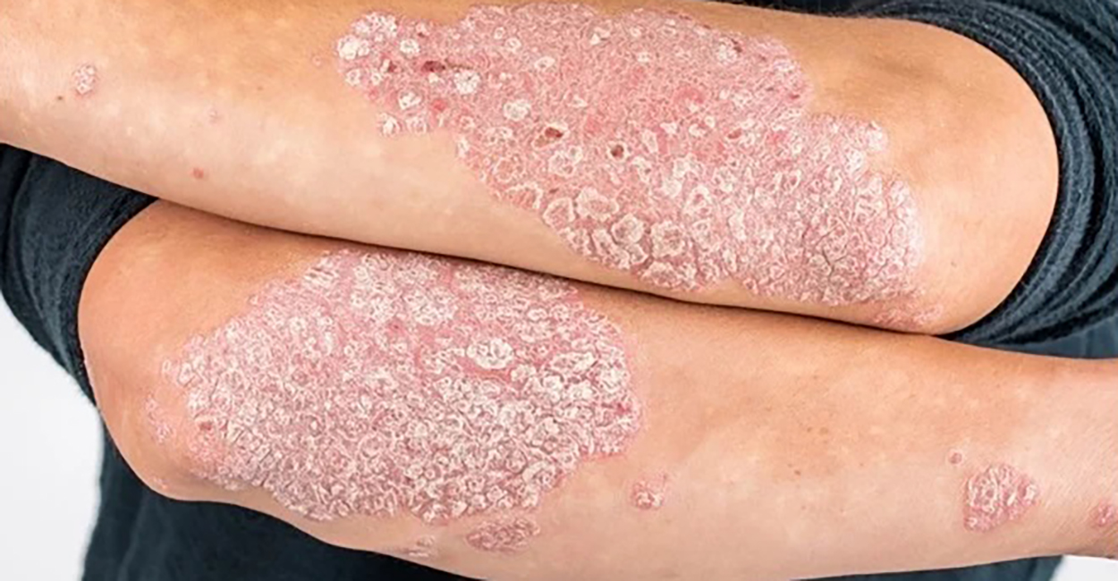 Psoriasis