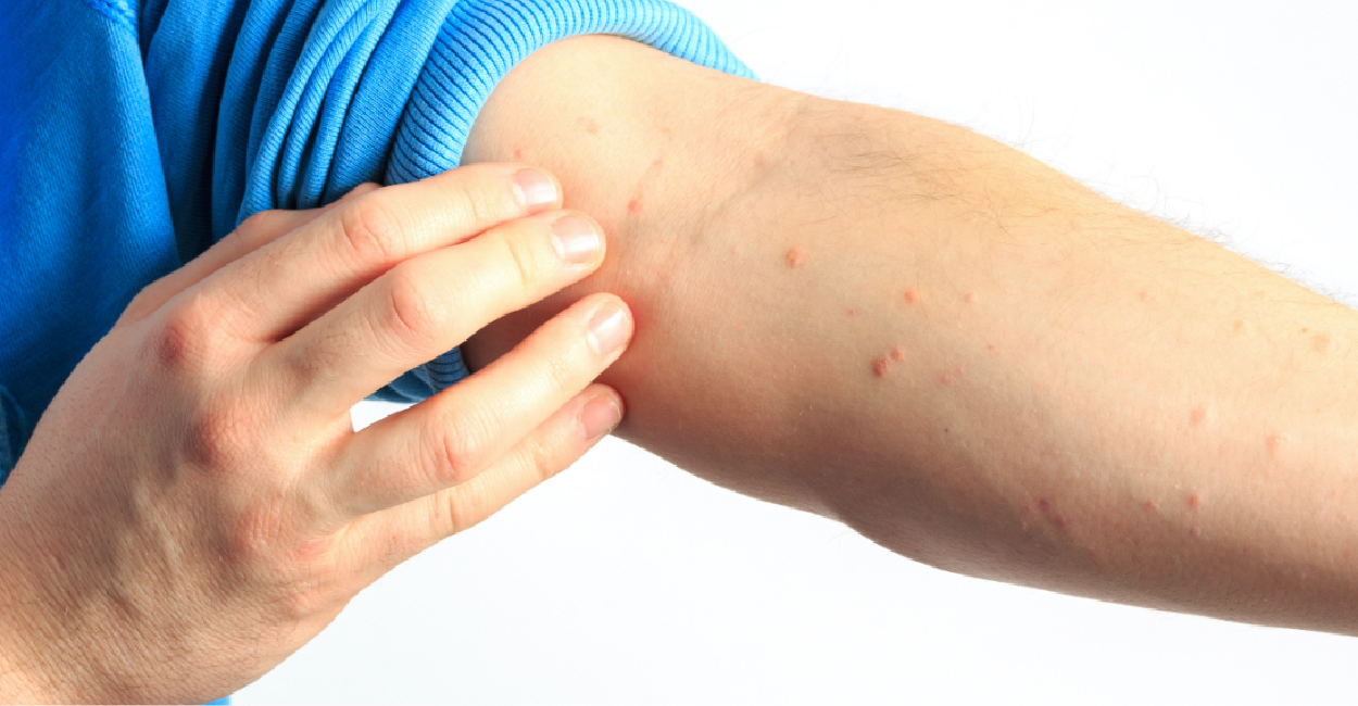 Urticaria