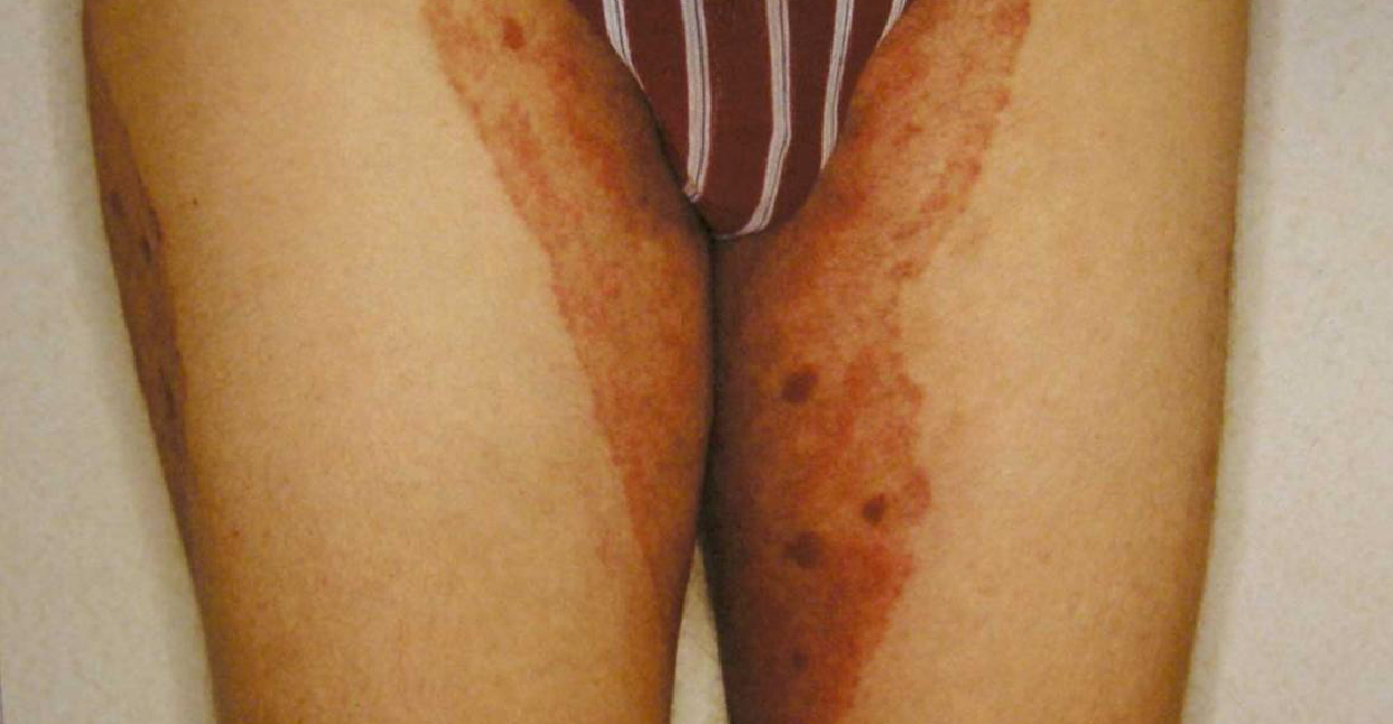 Fungal Infection